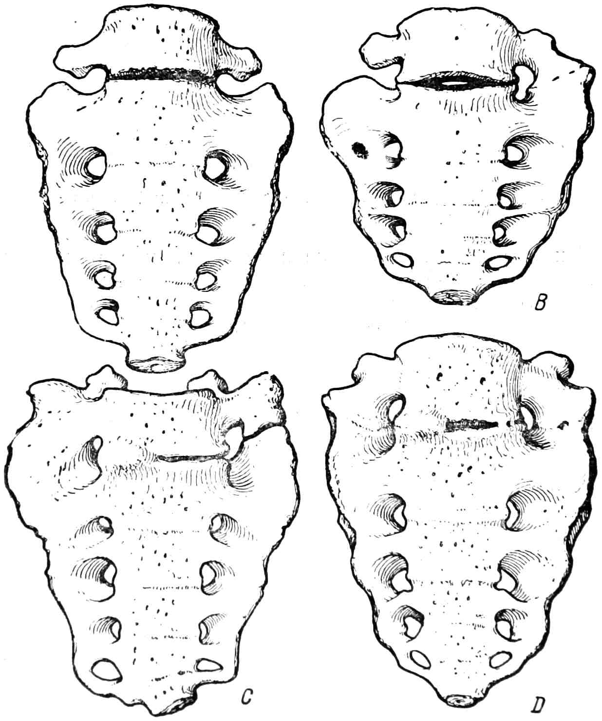 Рис. 316. Sacralisatio vertebrae lumbalis quinti.