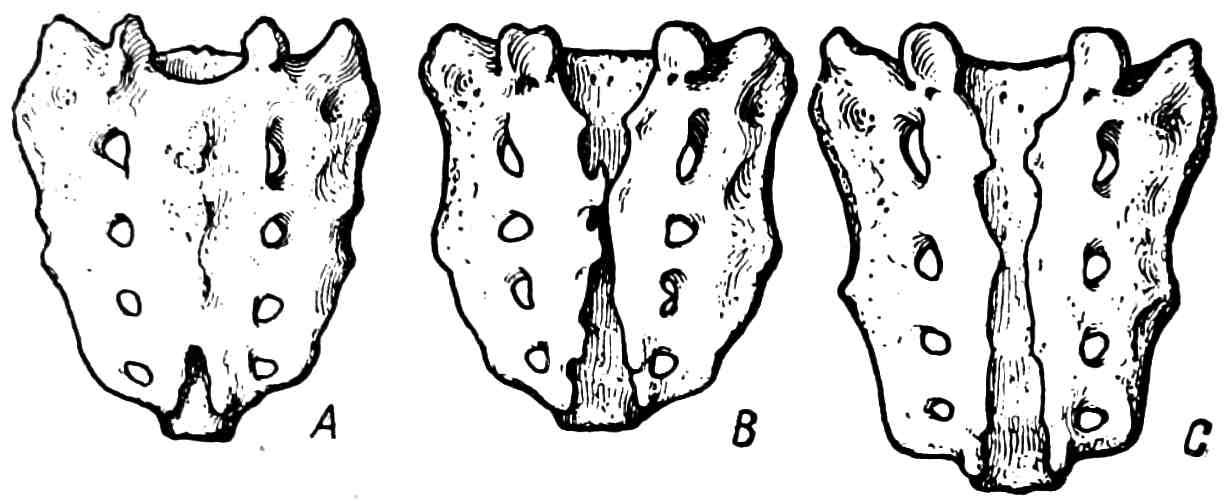 Рис. 317. Spina bifida sacralis (Сперанский, 1925).