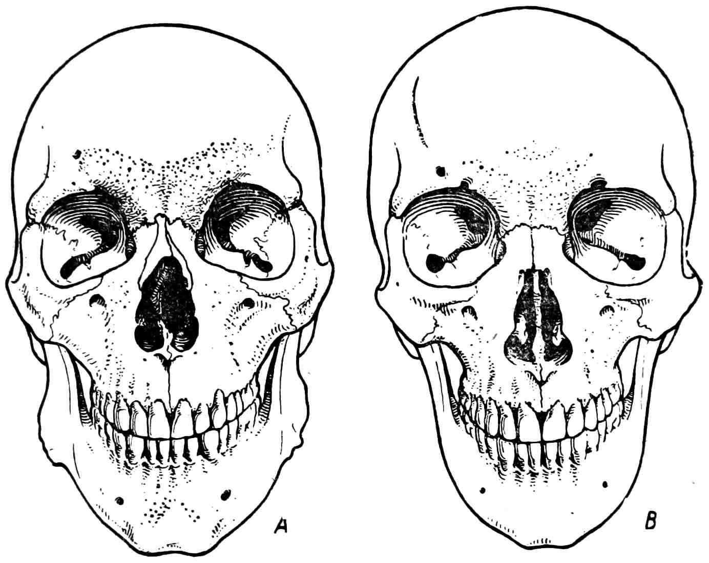 Рис. 322. А — редукция носовых костей; В — полное отсутствие носовых костей.