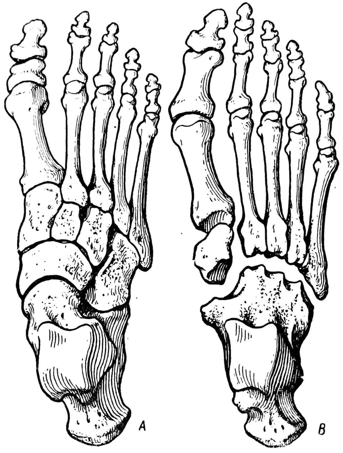 Рис. 336. А — стопа с двумя фалангами на каждом пальце; В — стопа со сросшимися тарзальными костями (Н. С. Маркелов, 1929).