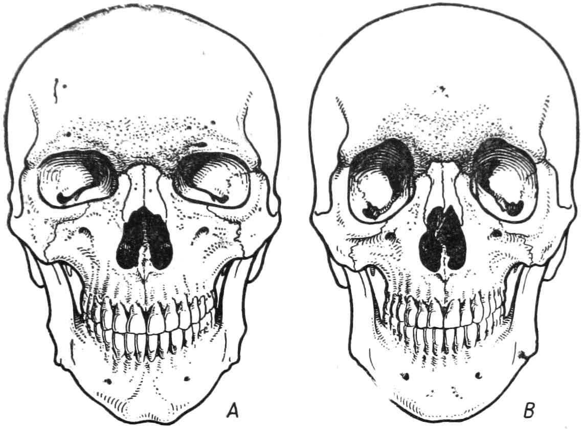 Рис. 342. A — череп с низкими и широкими орбитами; B — череп с высокими и узкими орбитами.